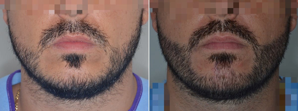 Hair Restoration before and after, frontal.