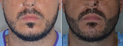 Hair Restoration before and after, frontal.