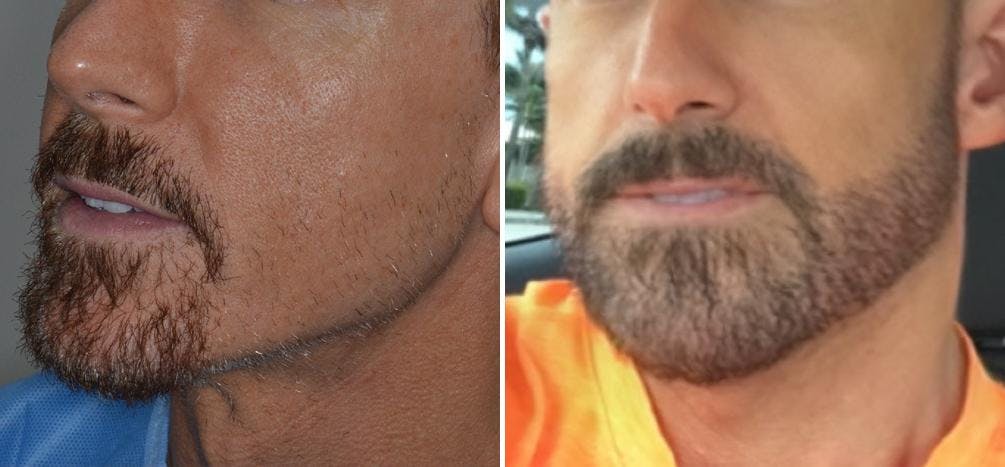 Hair Restoration before and after, oblique left.