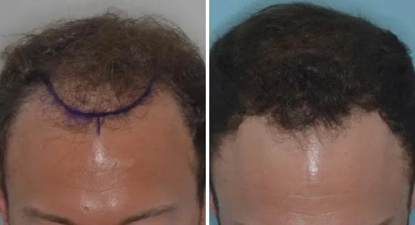 Hair Restoration before and after, marked.