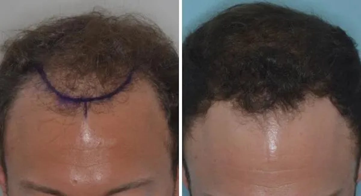 Hair Restoration before and after, marked.