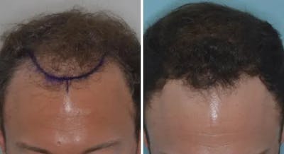 Hair Restoration before and after, marked.