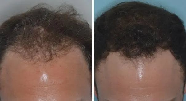 Hair Restoration before and after, frontal.
