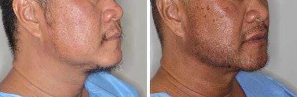 Hair Restoration before and after, oblique right.