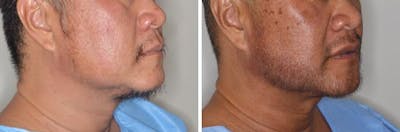 Hair Restoration before and after, oblique right.