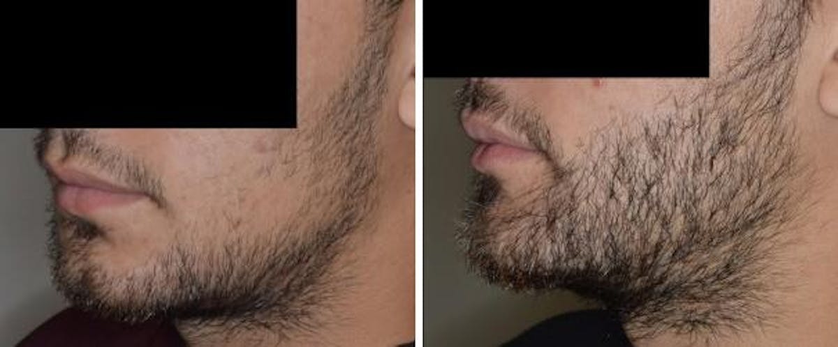 Hair Restoration before and after, lateral left.