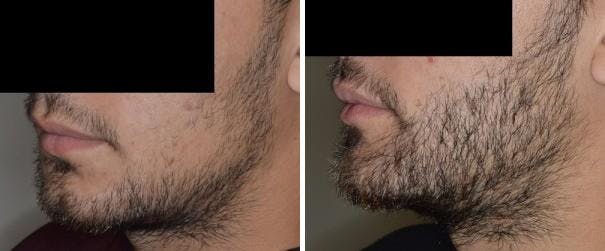 Hair Restoration before and after, lateral left.