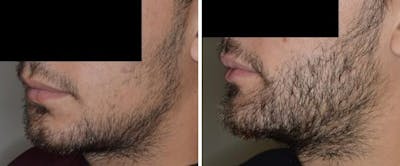 Hair Restoration before and after, lateral left.