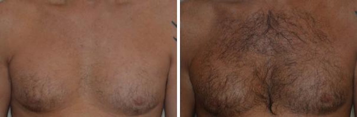 Hair Restoration before and after, frontal.