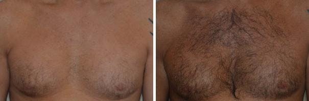 Hair Restoration before and after, frontal.