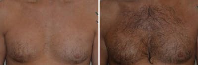 Hair Restoration before and after, frontal.