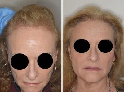 Hair Restoration before and after, frontal.