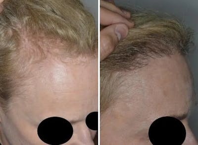 Hair Restoration before and after, oblique right.