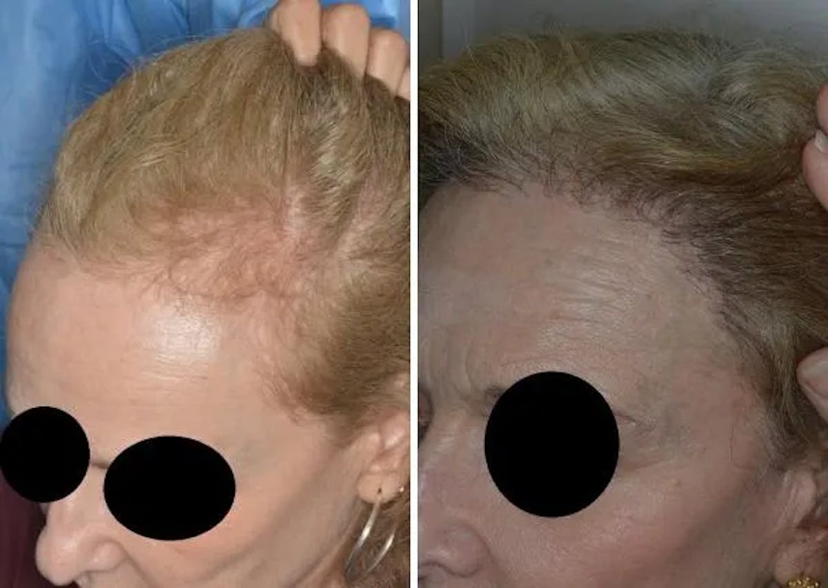 Hair Restoration before and after, oblique left.
