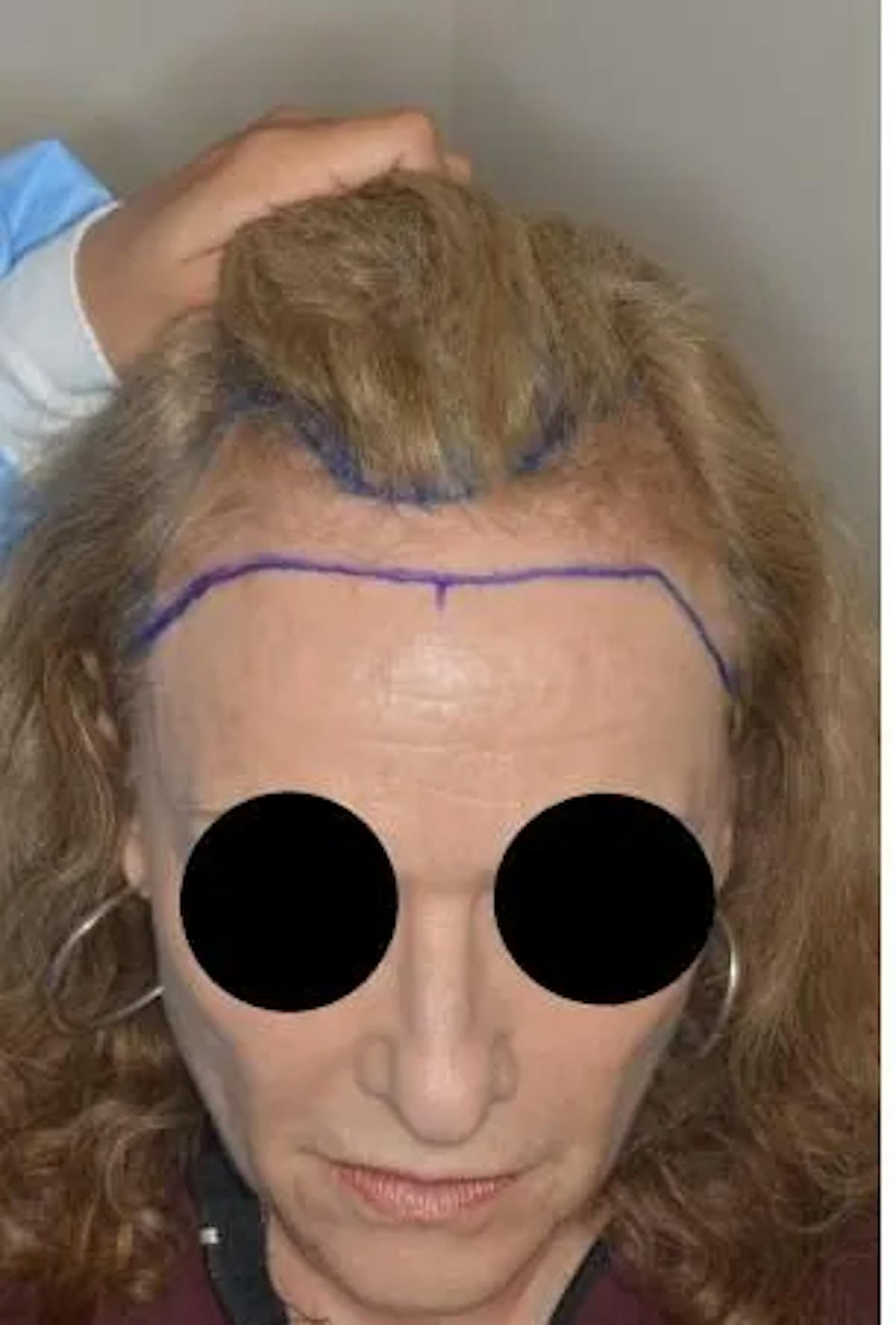 Hair Restoration before and after, marked.