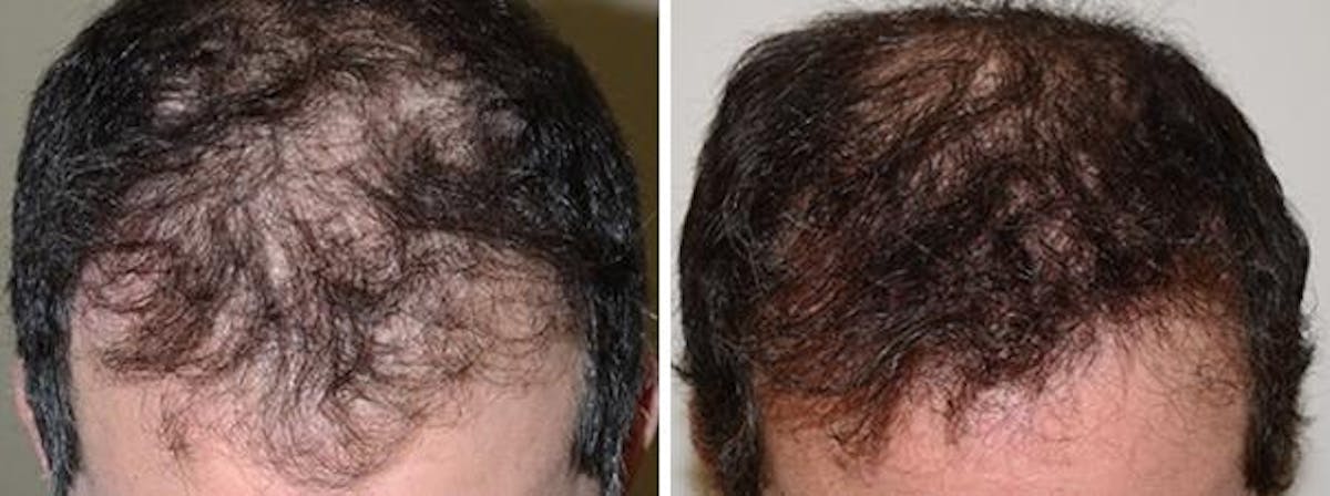Hair Restoration before and after, frontal.