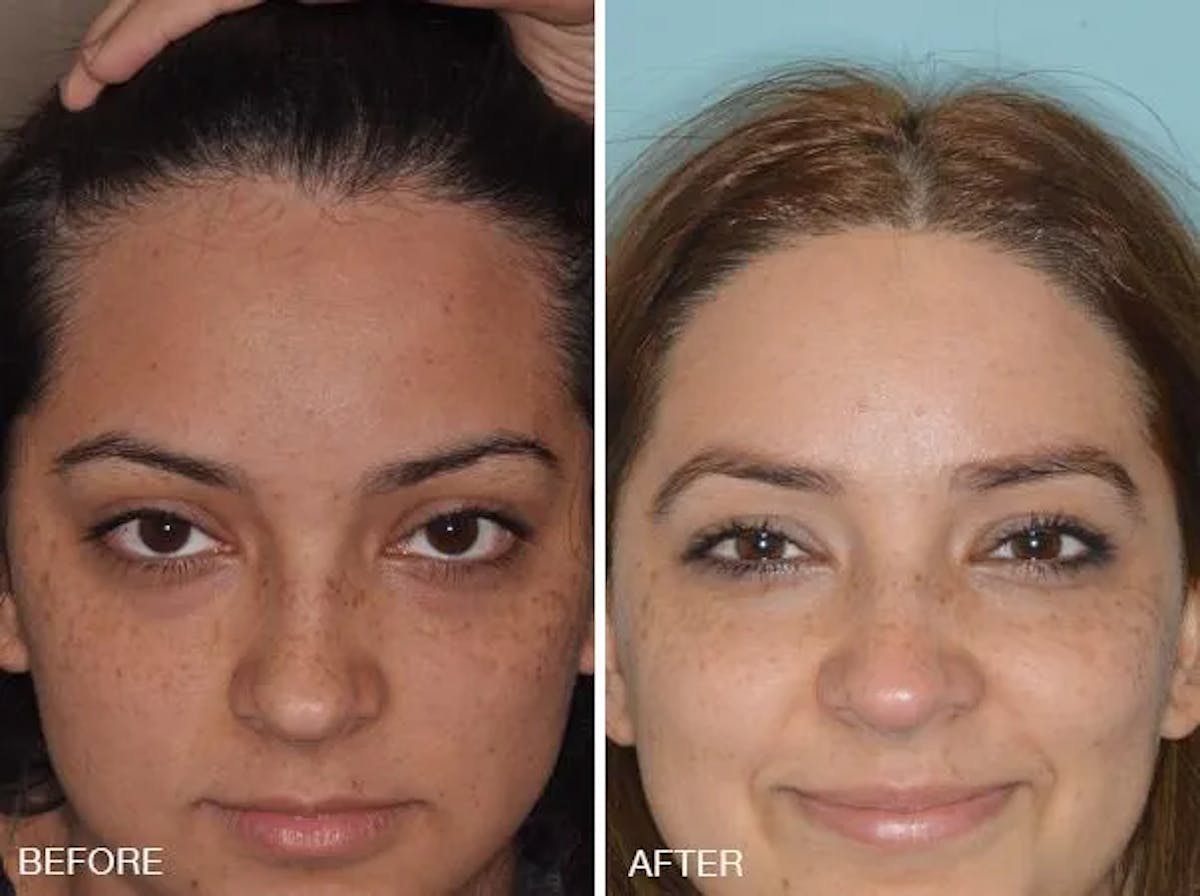 Hair Restoration before and after, frontal.