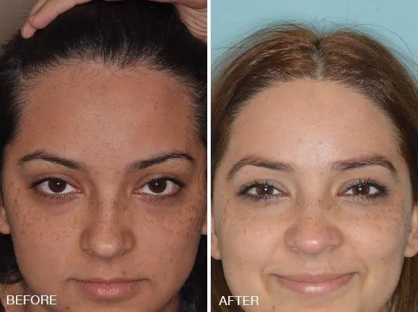 Hair Restoration before and after, frontal.