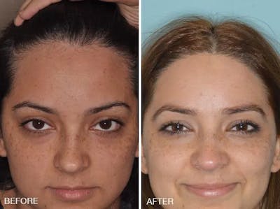 Hair Restoration before and after, frontal.