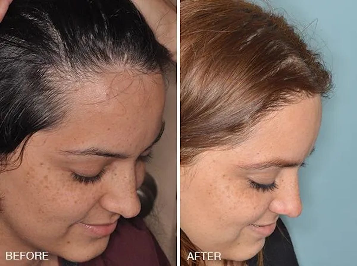 Hair Restoration before and after, oblique right.