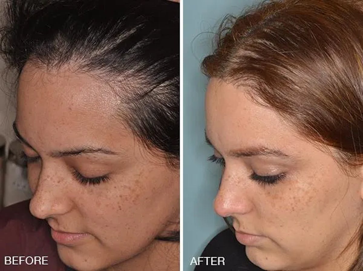Hair Restoration before and after, oblique left.