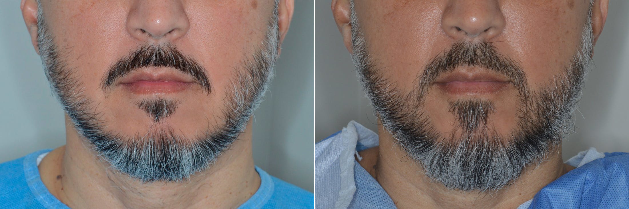 Hair Restoration before and after, frontal.