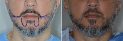 Hair Restoration before and after, frontal.