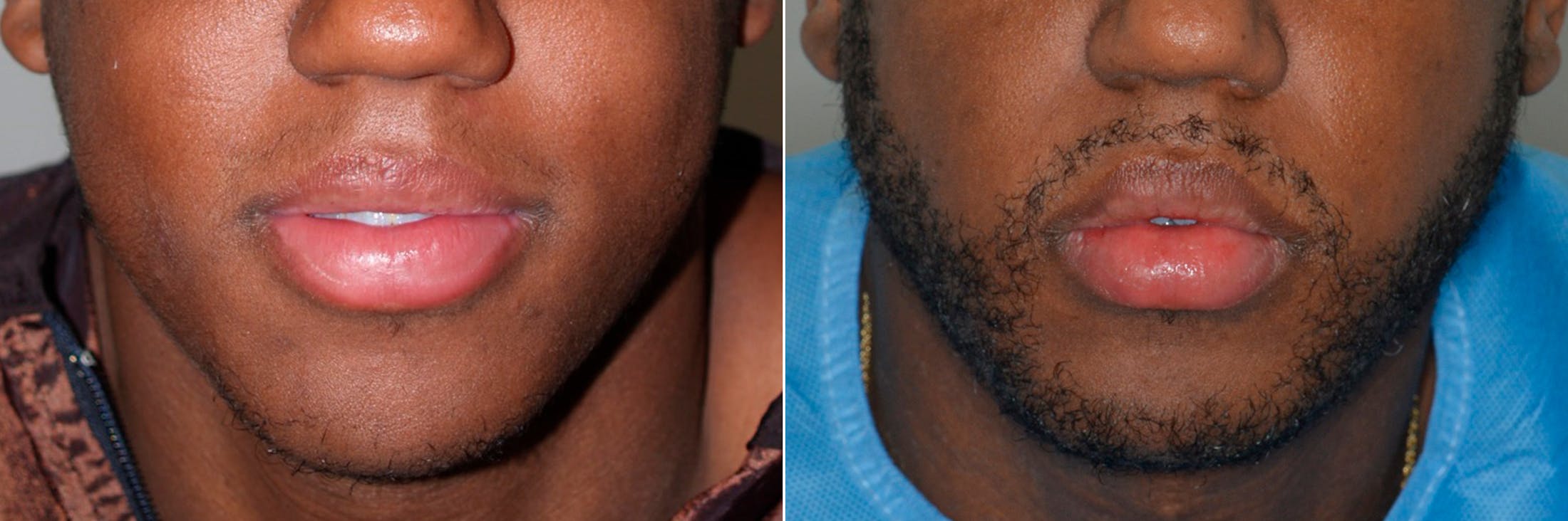 Hair Restoration before and after, frontal.