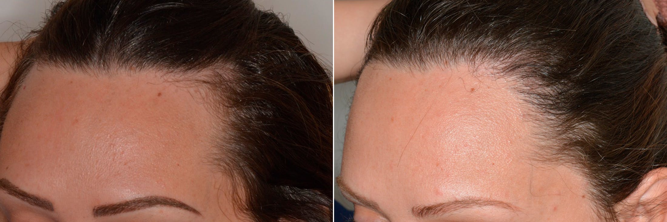Hair Restoration before and after, oblique left.