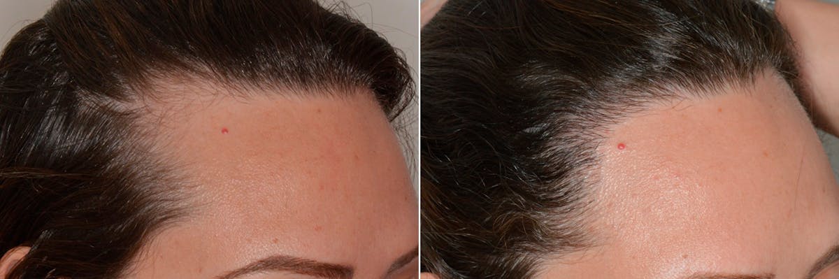 Hair Restoration before and after, oblique right.