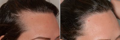 Hair Restoration before and after, oblique right.
