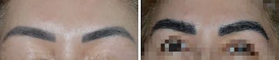 Eyebrow Transplant before and after, frontal.