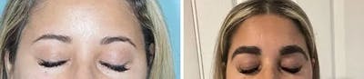 Eyebrow Transplant before and after, frontal.