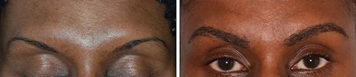 Eyebrow Transplant before and after, frontal.