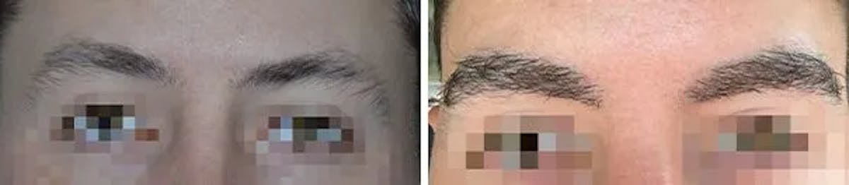 Eyebrow Transplant before and after, frontal.