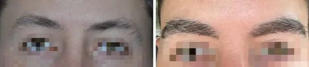 Eyebrow Transplant before and after, frontal.