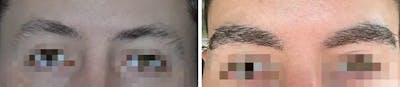 Eyebrow Transplant before and after, frontal.