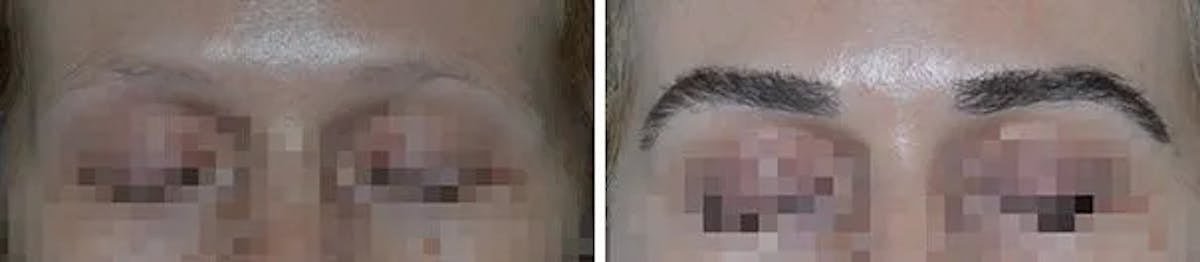 Eyebrow Transplant before and after, frontal.