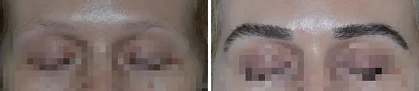 Eyebrow Transplant before and after, frontal.