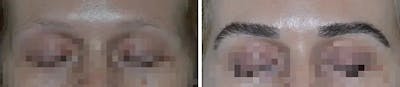 Eyebrow Transplant before and after, frontal.