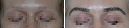 Eyebrow Transplant before and after, frontal.