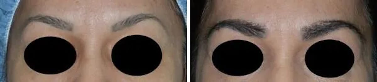 Eyebrow Transplant before and after, frontal.