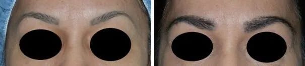 Eyebrow Transplant before and after, frontal.
