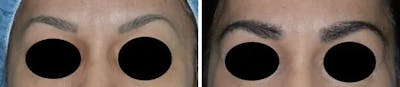 Eyebrow Transplant before and after, frontal.
