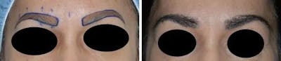 Eyebrow Transplant before and after, marked.