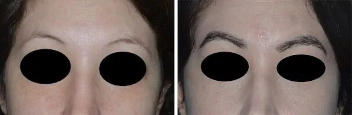 Eyebrow Transplant before and after, frontal.