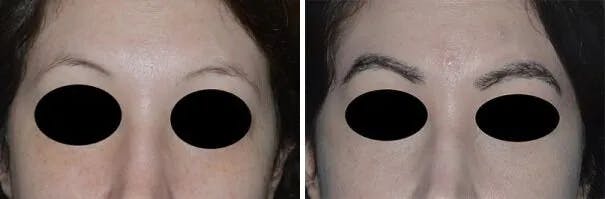 Eyebrow Transplant before and after, frontal.