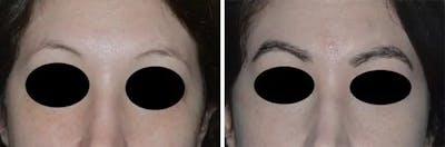 Eyebrow Transplant before and after, frontal.