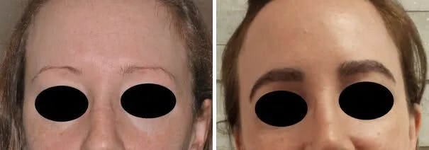Eyebrow Transplant before and after, frontal.