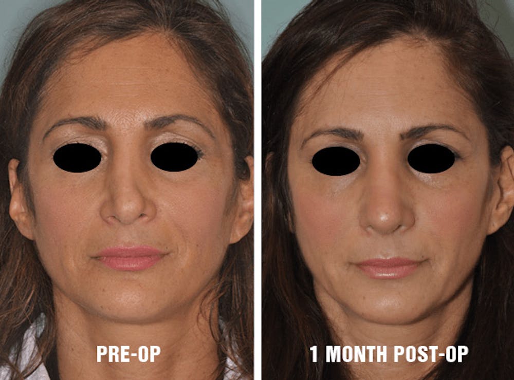 Rhinoplasty before and after 1 month Woman post-operative results before and after 1 month